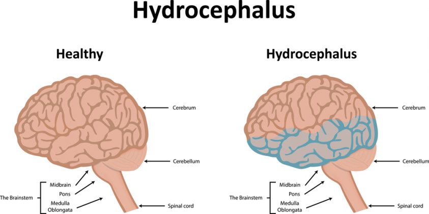 Гидроцефалия головного мозга у ребенка фото