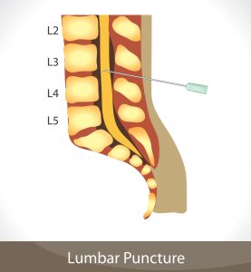 Люмбальная пункция техника показания противопоказания
