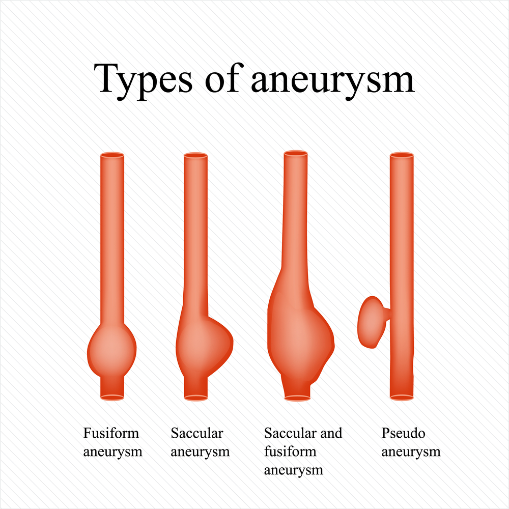 Аневризма головного мозга что это такое