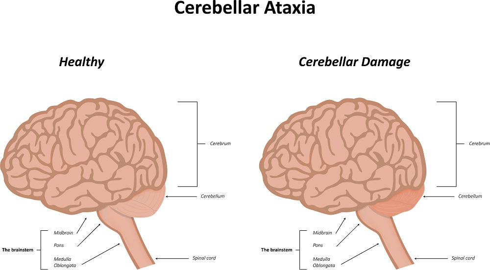 Мозжечковая атаксия лечение народными средствами